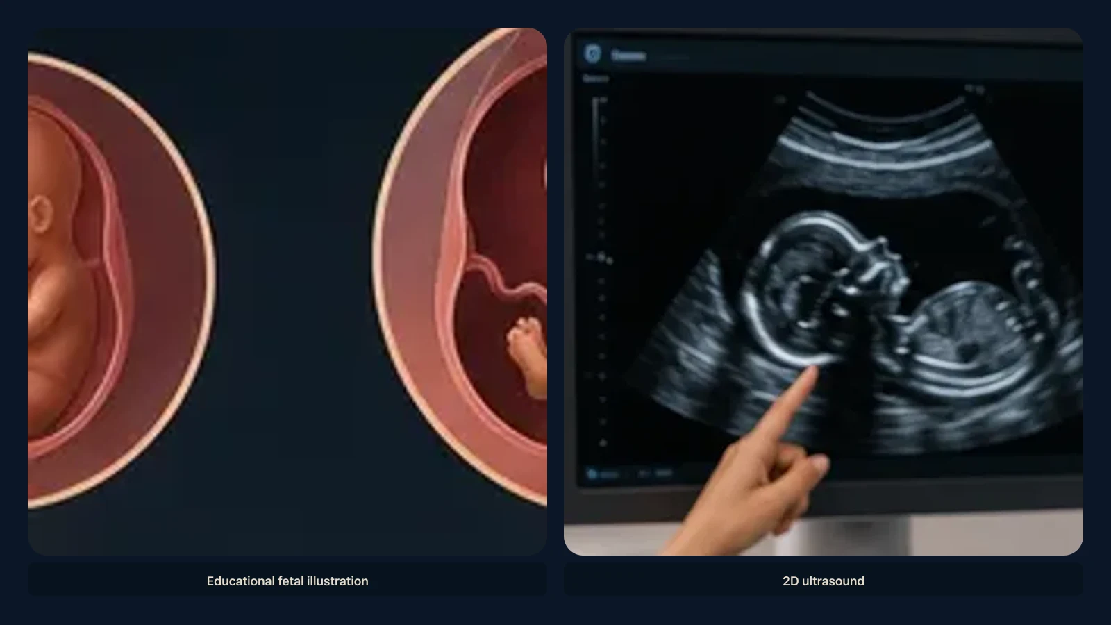 Educational visual for what a baby may look like at 20 weeks on ultrasound. Educational illustration; not a diagnostic ultrasound image.