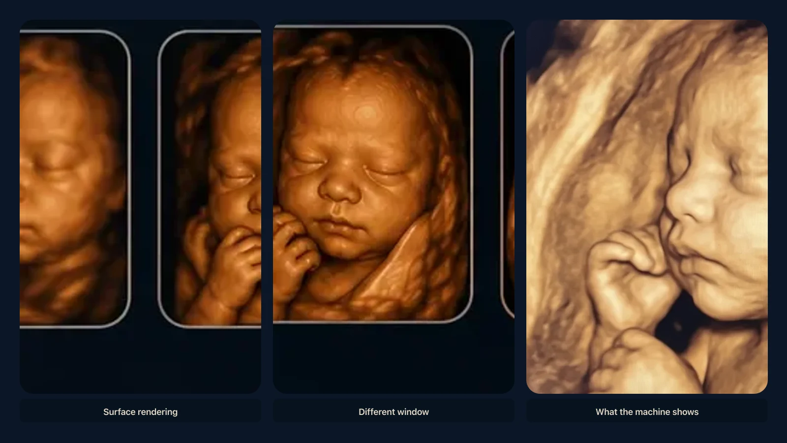 Educational visual for why a 3D ultrasound can look strange. Educational illustration; not a diagnostic ultrasound image.