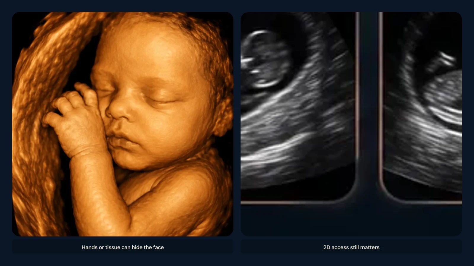 Educational visual for why a baby’s face can be hard to see on ultrasound. Educational illustration; not a diagnostic ultrasound image.