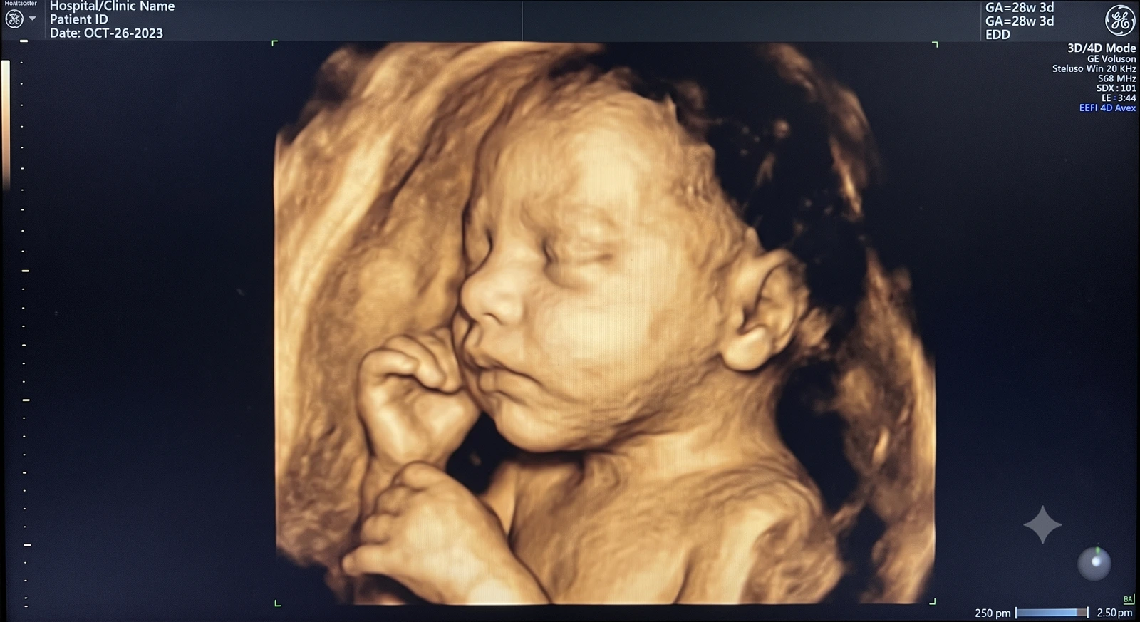 Timeline illustration showing gestational weeks with ultrasound imaging quality indicators