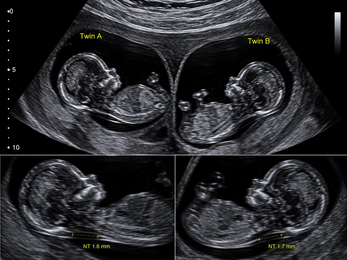Twin Pregnancy Ultrasound